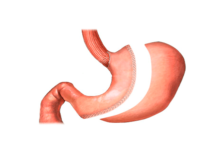 Gastrectomia Vertical O Manga Gastrica Obexit